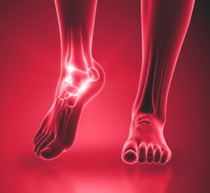 Ankle Pain Illustration