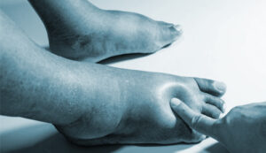 Diabetic Foot Image