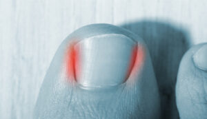 Ingrown Toe Nail Image